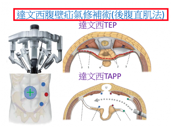 達文西腹壁疝氣手術精準快速安全傷口小