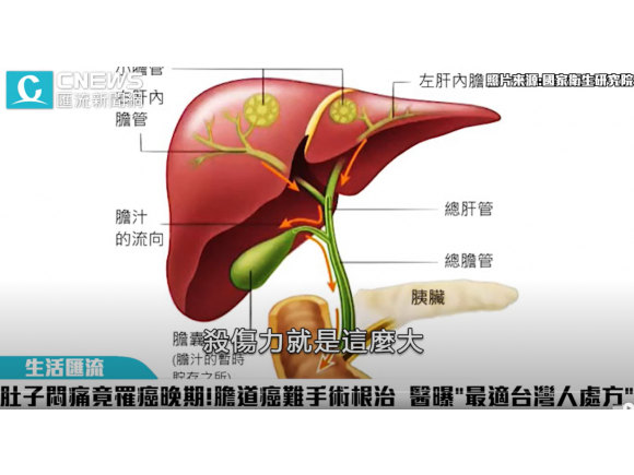 肚子悶痛竟罹癌晚期！膽道癌難拚手術根治 醫曝「最適台灣人處方」